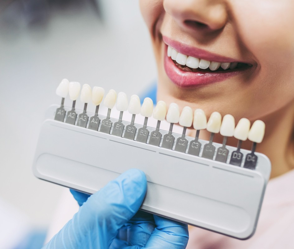 Traitement esthétique au cabinet du Dr Christian Maire à Lisbonne : facettes dentaires