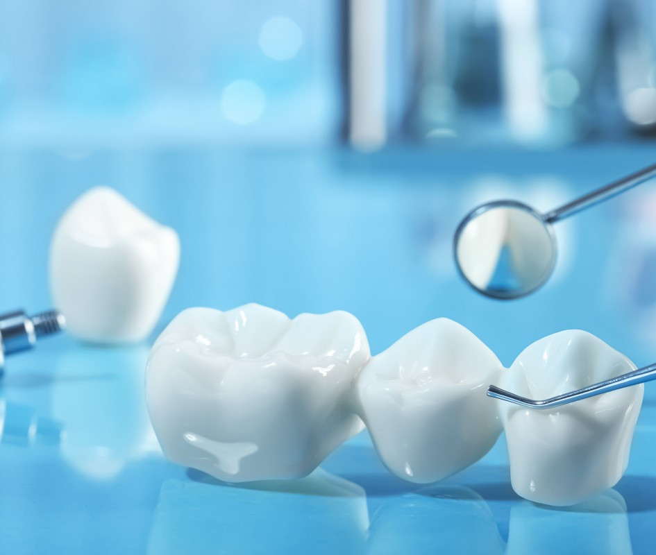 Couronnes au cabinet dentaire du Dr Maire à Lisbonne