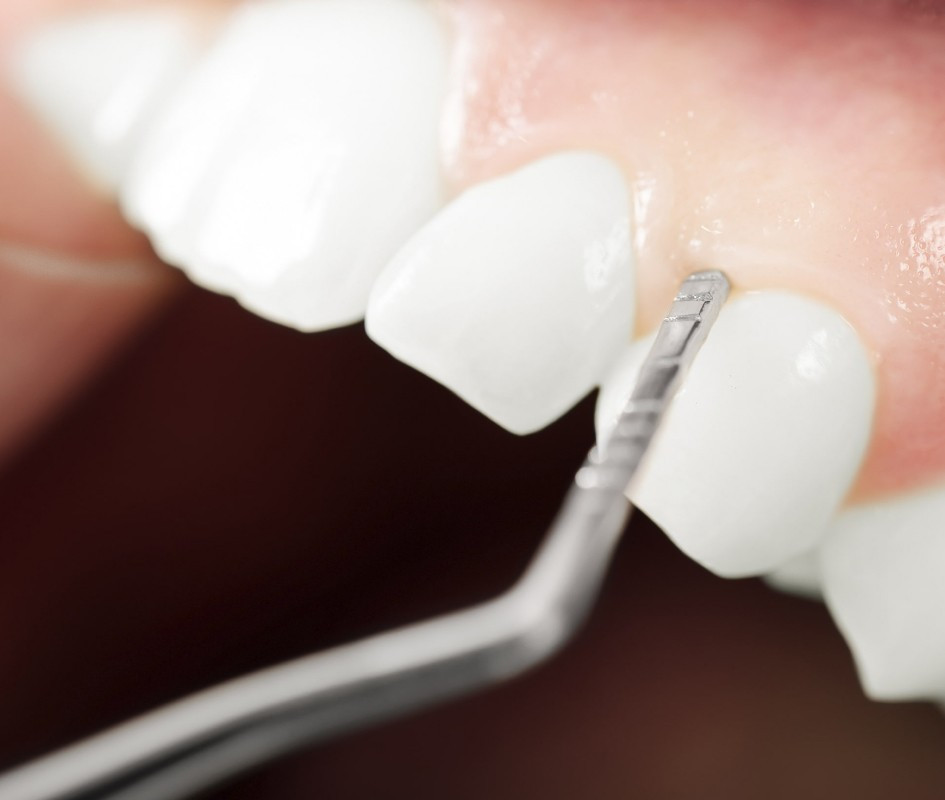 Greffe osseuse au cabinet du Dr Maire à Lisbonne, Augmentation osseuse Sinus Lift PRF