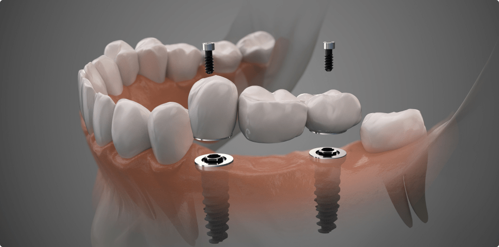 Implants dentaires au cabinet dentaire du Dr Christian Maire à Lisbonne